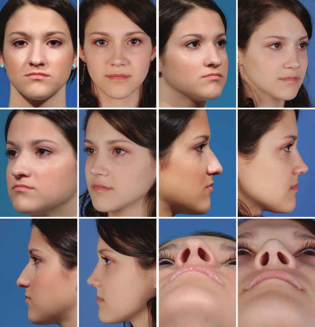 Volume 134, Number 1 Decreasing Nasal Tip Projection Fig. 8. Case example of an 18-year-old female patient undergoing primary rhinoplasty. Postoperative results are at 1 year.