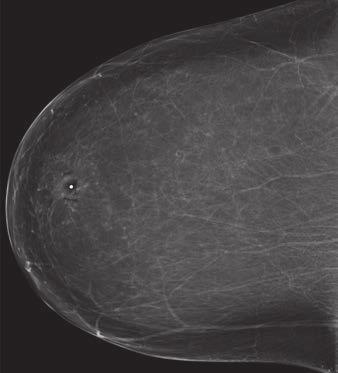 Breast Cancer Screening whole, the mortality reduction benefit of screening mammography outweighs the drawbacks.