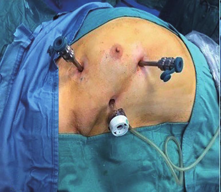 The lesion was suspected to be either a mediastinal lipoma or a Morgagni hernia and because a definite preoperative diagnosis could not be made, we preferred a transthoracic approach using a