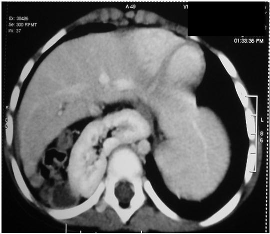 Figure 2: CECT thorax, axial section showing liver, bowel, and kidney in a