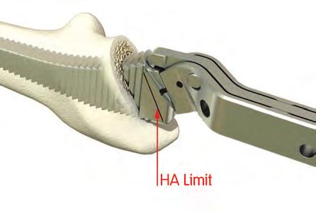 The level of the HA coating is indicated on the rasp.