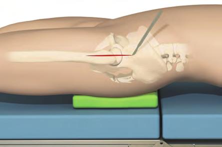 Surgical Technique Position of the patient and approach For the purpose of this description a lateral approach is chosen. Surgery is performed with the patient in an extended supine lateral position.