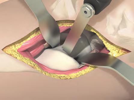 All implants and instruments also suit a minimally invasive approach.