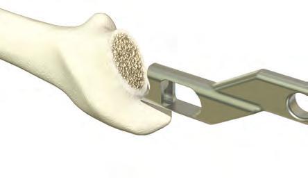 trochanter. The height of the neck resection may be modified in the presence of abnormal anatomy as determined by preoperative templating and intraoperative measurements.