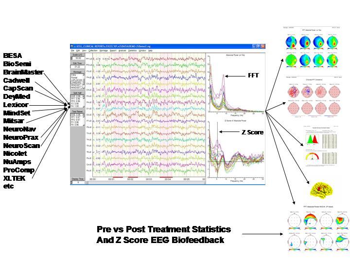 Página 1 de 6 NeuroGuide EEG and QEEG Analysis System NeuroGuide the most informative and comprehensive Conventional EEG and QEEG analysis system available.