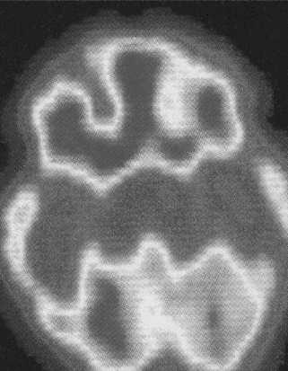 Physiology: over-arousal of frontal lobe areas involved in directing attention and impulse control, as in PET Scan of brain of person with Obsessive/ Compulsive disorder (top); high metabolic