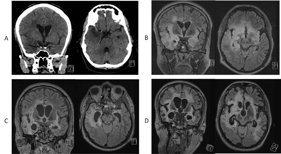 83 84 85 86 87 88 89 90 91 92 93 Figure Legend 1: Neuroimaging A: Cranial CT scan at the day of admission (coronarl, left, and axial slices, right) shows a hypodense area of the right temporal lobe.
