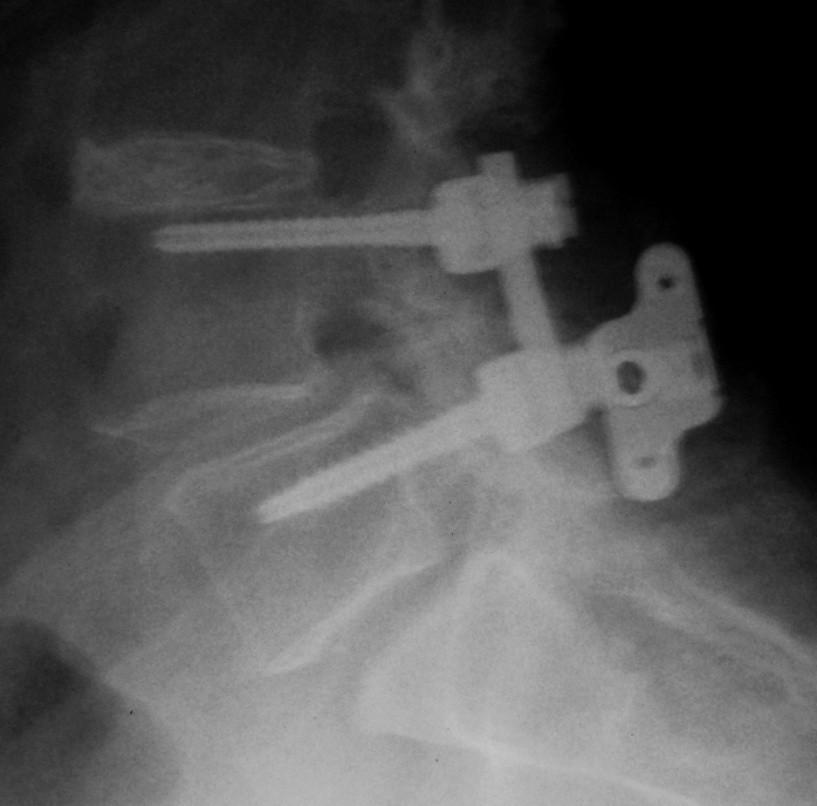 76 years, osteoporosis Stenosis and spondylo L4 Bilateral