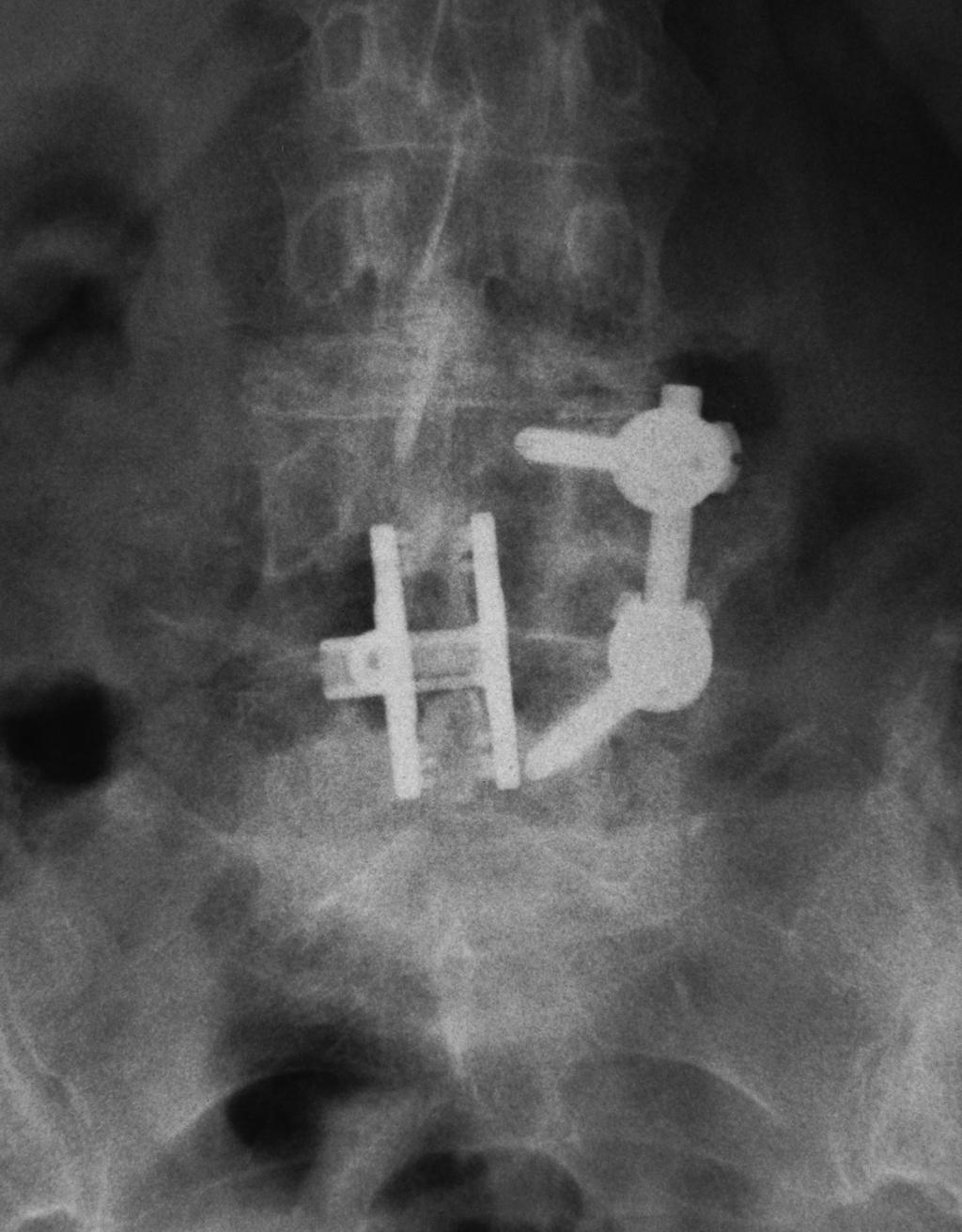 fusion unilateral left (unstable screws on right side)