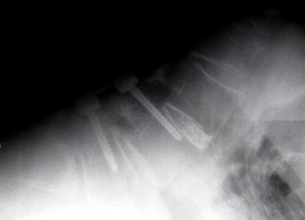 x-rays: mild hypermob.