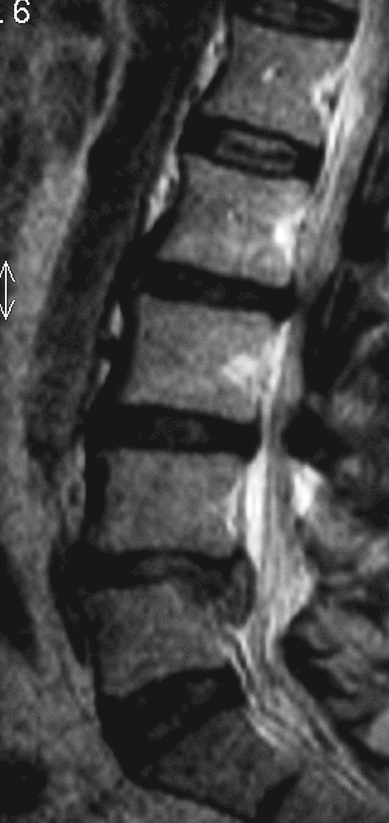 Post-discectomy low back pain unloaded under load