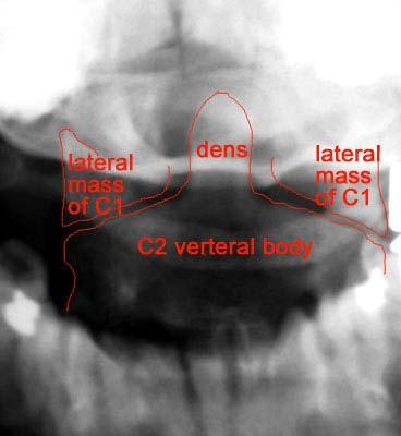 Odontoid view Adequacy: all of the dens and lateral borders of C1 & C2