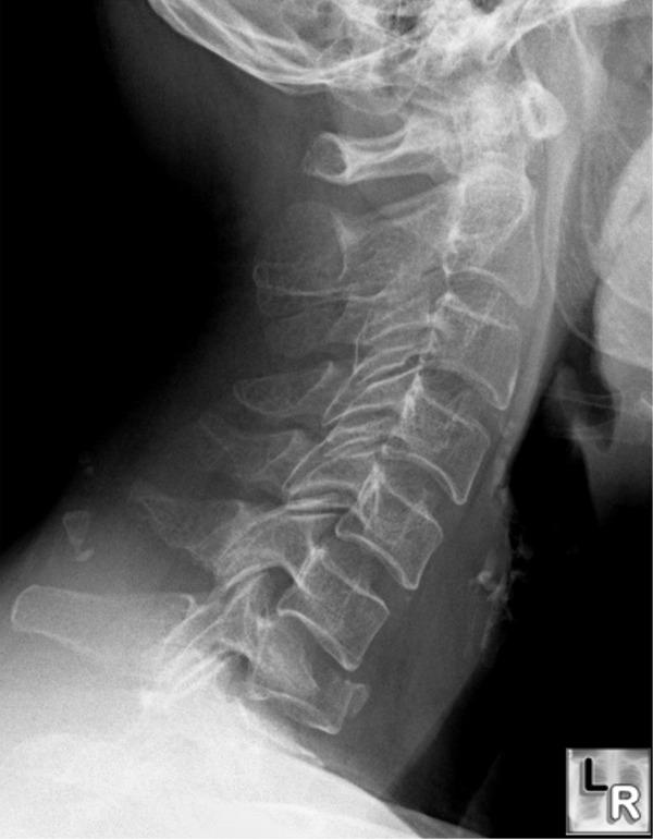 Fractures Burst Fracture Fracture of C3-C7 from axial loadinng Spinal cord