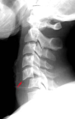 Fractures Bilateral Facet Dislocation Flexion injury Subluxation of dislocated vertebra of greater than