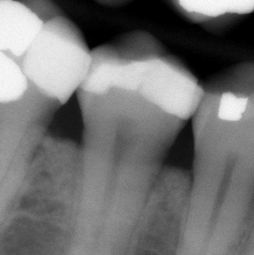 Remaining dentin thickness Shallow cavity