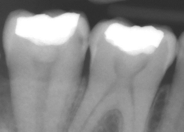 Remaining dentin thickness Moderate cavity