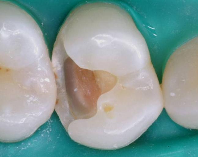 Before cavity preparation the