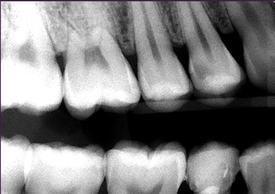 in for what to expect of cavity depth