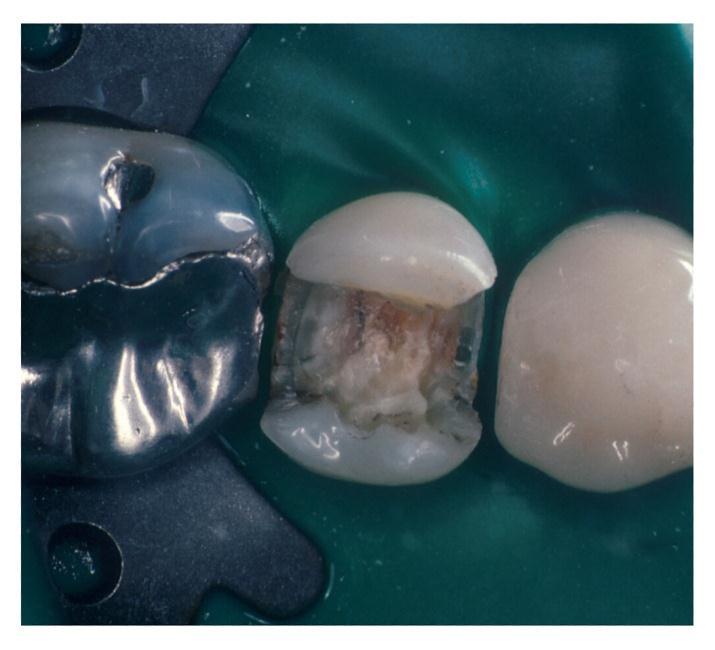 Decision making in the use of sealers, liners and/or bases Remaining dentin thickness