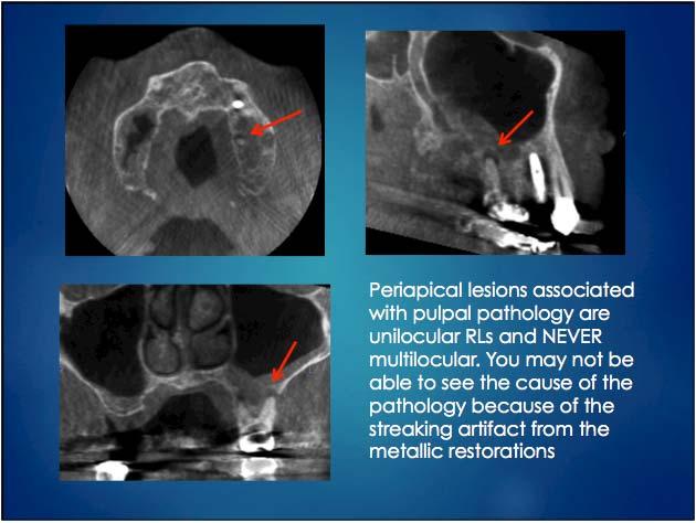 most common odontogenic pathology Usually incidental finding on CT scans Periapical lesions associated