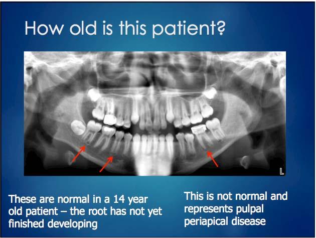 Periapical cemental dysplasia When it becomes more extensive it is known as florid cemento-osseous