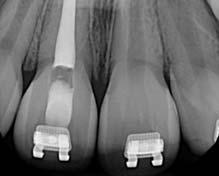 Replanted tooth with mature root formation Replanted tooth