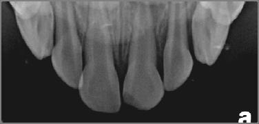 Yellow Observe for Internal Resorption Remove Observe for External Resorption Chronic and Does Not Show Periapical Radiolucency Watch Acute with a Periapical Radiolucency Remove Yellow Observe for