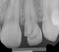 Crown Root Fracture Non