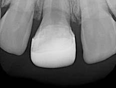 dentin, osteodentin, or cementum b.