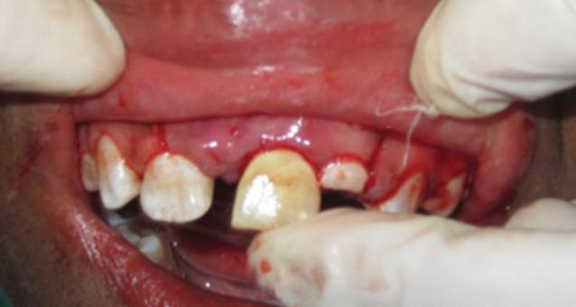 Subluxated tooth with discoloration and necrosis upon recall examination.
