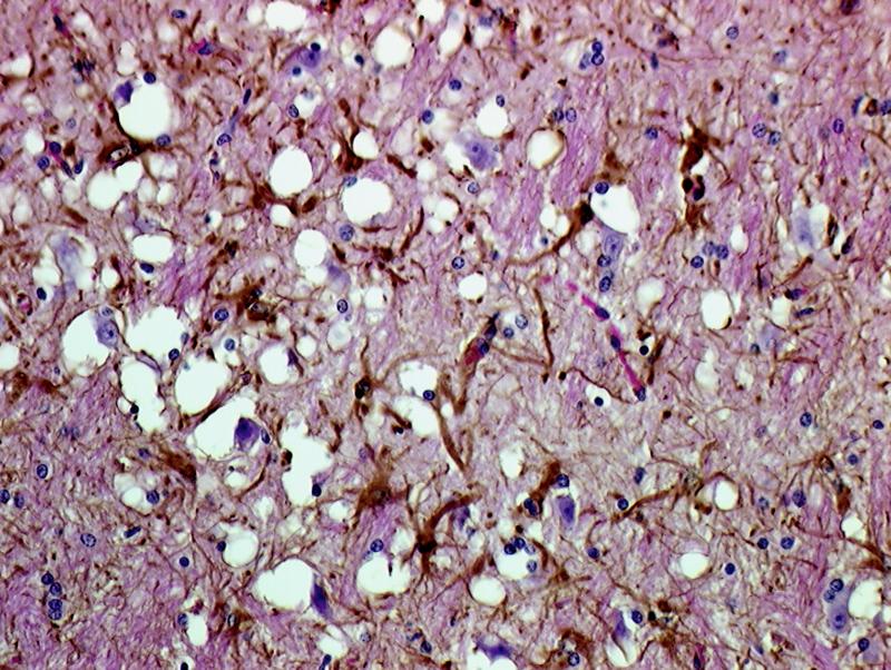 Spongiform Infected brain has sponge-like holes throughout Severe psychomotor dysfunction Each disease
