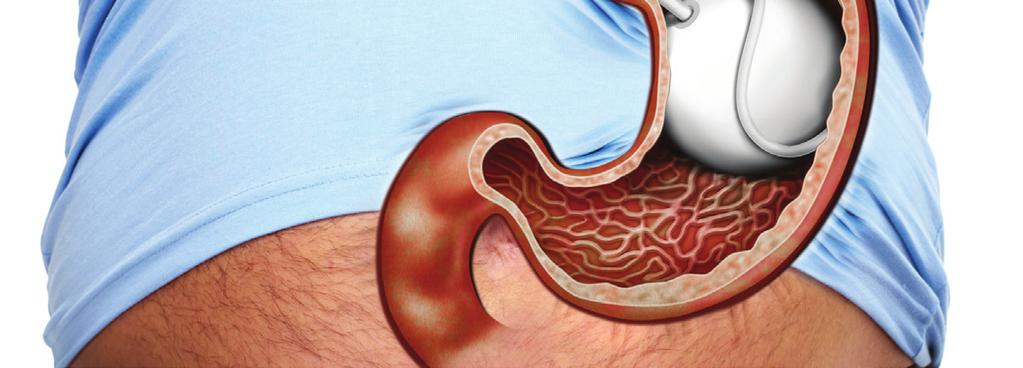 Information on Intragastric Balloon provided BY Dr. Mustafa EL Hakam A-How it works? The saline-filled balloon occupies about one-third of the stomach cavity.