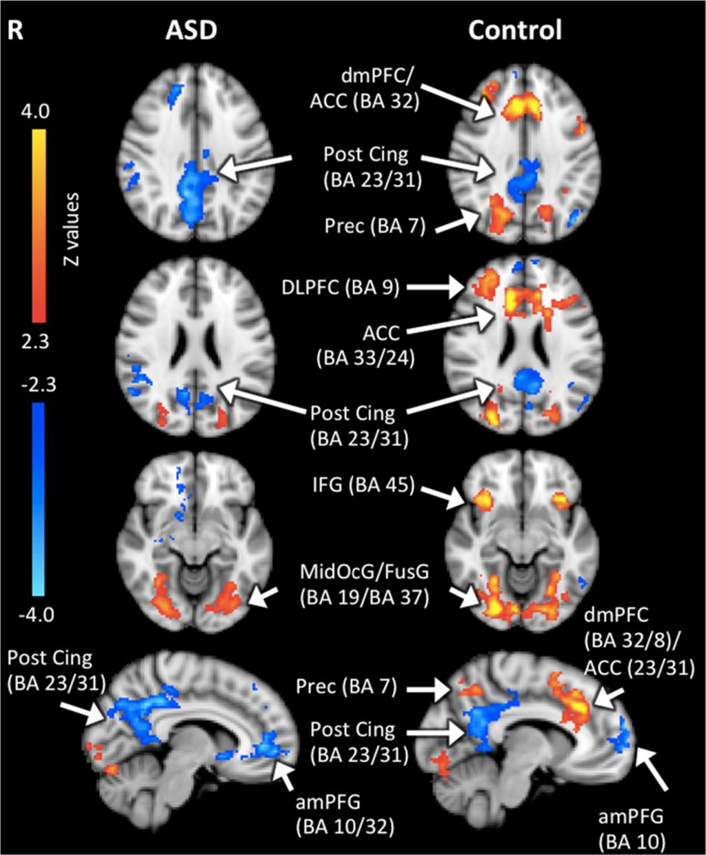 Vogan et al. Journal of Neurodevelopmental Disorders 2014, 6:19 Page 9 of 15 Figure 3 Group activation maps for the linear trend analyses in ASD and TD groups during CMT.