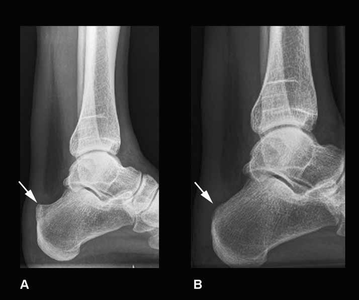 (A) Preoperative X-ray, with retrocalcaneal bursitis and prominence of the
