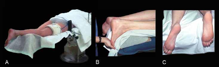 164 Figure 3. The patient is placed in prone position (A). The affected right leg is placed on a bolster and right over the end of the table (B).