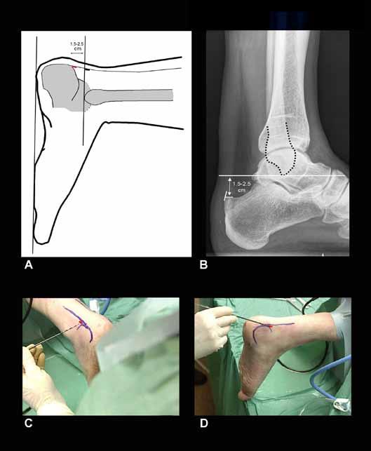 A line is drawn through the tip of the fibula parallel to the sole of the foot.