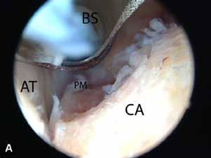 (B) Retrocalcaneal bursa is removed with bonecutter shaver.