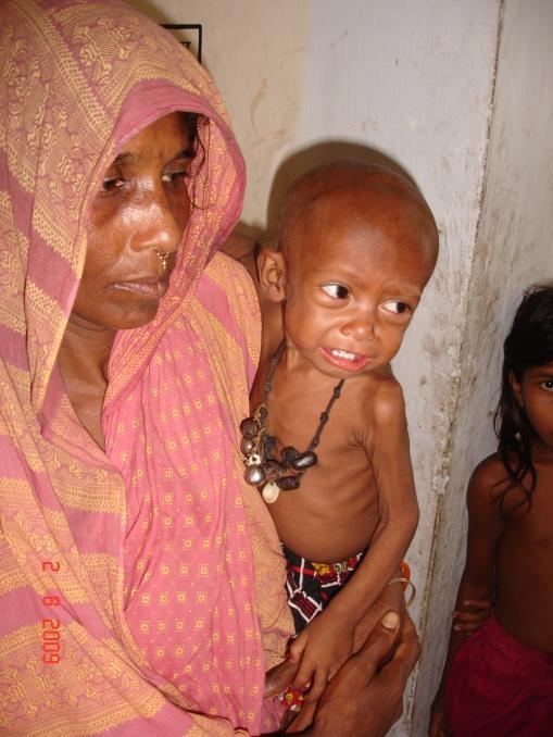 Bangladesh: background Bangladesh has 4 th highest number of children with severe acute malnutrition (SAM) in the world National nutrition programs focused on: Behavior Change Communication Growth