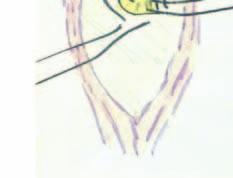 channel. (G) The catheter exits the outer fascia in a direction upwards and to the right before bending into the subcutaneous space.
