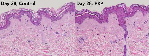 Representative hematoxylin and eosin stained images of biopsy samples obtained from control and PRP-treated side on postirradiation day 28 are shown in Figure 4.