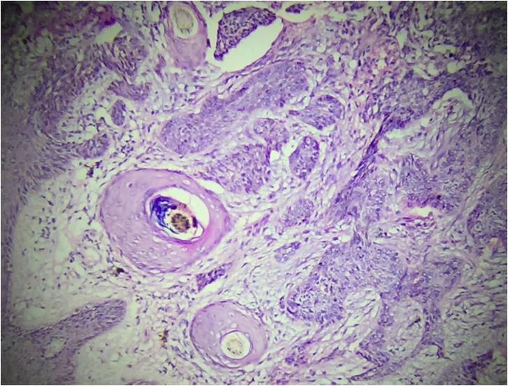 Fig 2:Trichoepithelioma - Microphotograph showing horn cyst