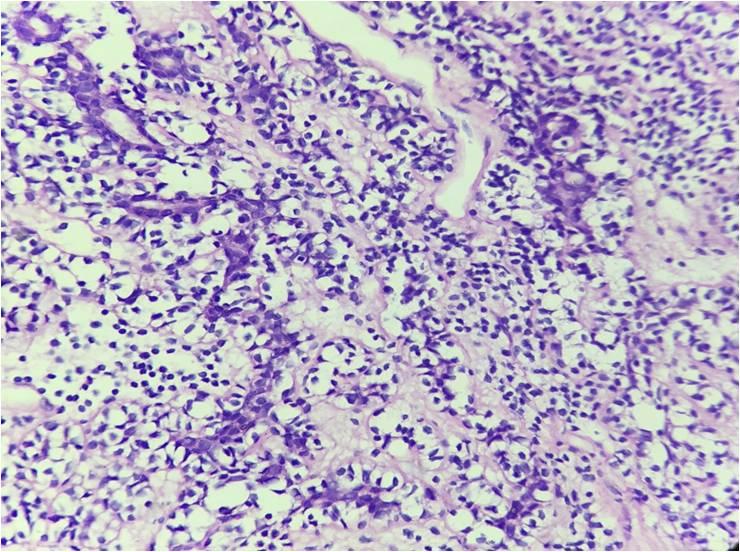 (H & E stain 10X) Fig 3: Clear cell hydradenoma - Microphotograph