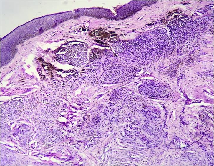 Fig 5:Intradermal nevus - Microphotograph showing nests of small nevus cells in the dermis.
