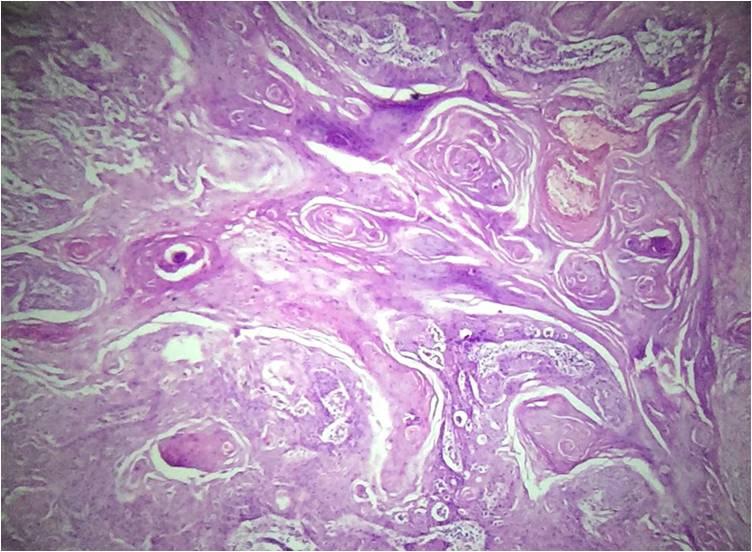 Fig 7: Squamous cell carcinoma - Microphotograph showing cells malignant cells