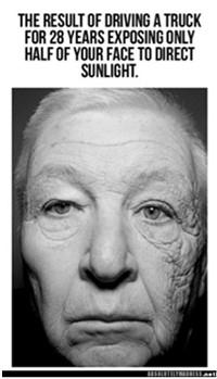 K.A. senile angiomas & de Morgan spots dilated capillary on skin surface very common