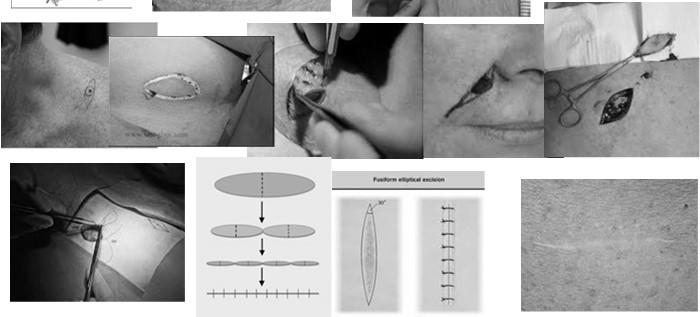 when used on appropriate NMSC s Technique is often used for removal of benign lesions Moh s Micrographic Surgery