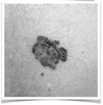 moles/dysplastic moles Family Hx of MM Previous NMSC Previous Melanoma Superficial Spreading