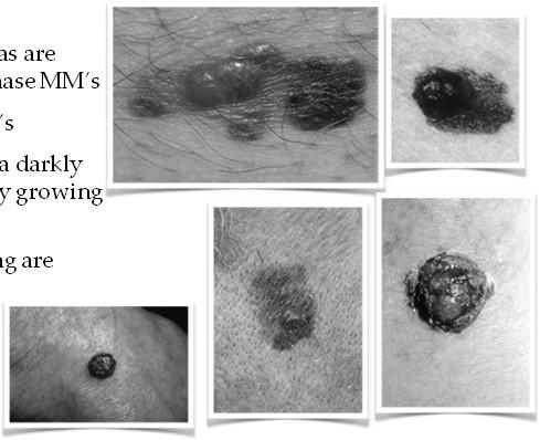 Maligna Melanoma Acral Lentiginous MM most common in sundamaged areas of older individuals