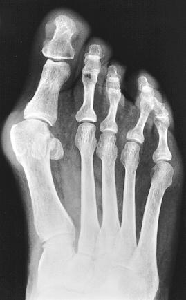 398 Patients and methods Ninety-six patients (114 feet) with symptomatic moderate to severe hallux valgus were treated with a proximal crescentic osteotomy and distal soft-tissue procedure between
