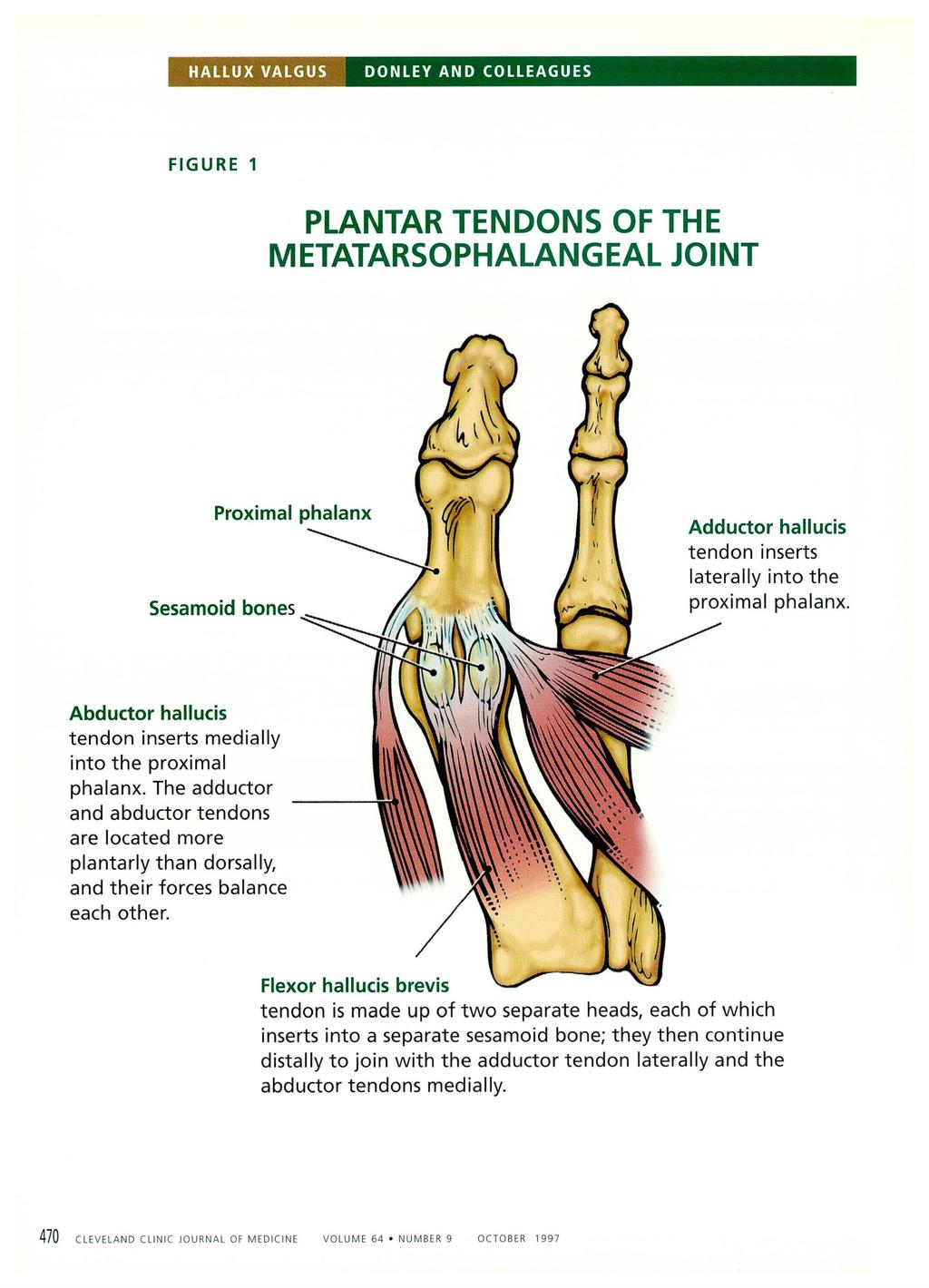 HALLUX VALGUS DONLEY AND COLLEAGUES FIGURE 1 PLANTAR TENDONS OF THE METATARSOPHALANGEAL JOINT Proximal phalanx Sesamoid bones Adductor hallucis tendon inserts laterally into the proximal phalanx.